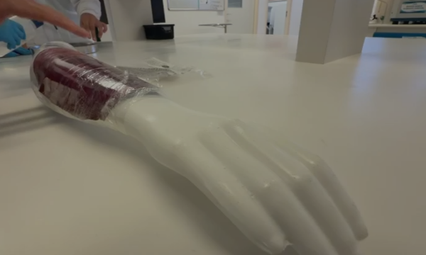 Pele de tilápia vira curativo para queimaduras e deve chegar ao SUS